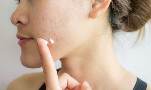 6 sai lầm khi chữa mụn trứng cá