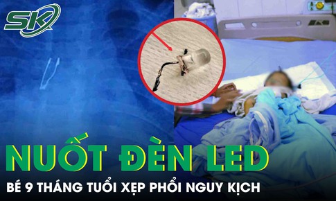 Kinh hoàng: Bé 9 tháng tuổi xẹp phổi vì nuốt bóng đèn LED