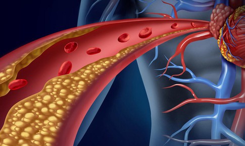Cholesterol cao không chỉ do ăn dầu mỡ, nguyên nhân chính thường bị bỏ qua