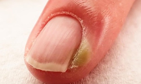 Chín mé ngón tay xử trí ra sao?