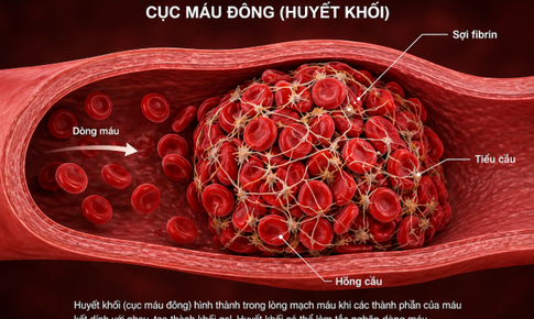 2 cách đơn giản ngăn ngừa cục máu đông