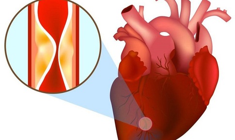 Bỗng dưng bị đau thắt ngực, cảnh giác với nhồi máu cơ tim