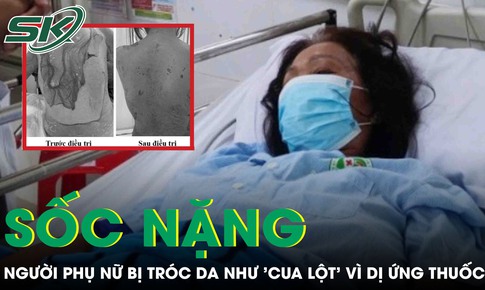 Tự ý dùng thuốc, người phụ nữ sốc nặng khi da bị tróc như 'cua lột' 