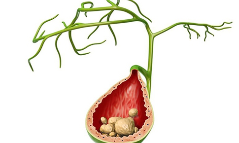 Vì sao sỏi mật hay tái phát và cách phòng ngừa hiệu quả