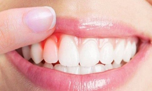 Nguyên nhân thường gặp gây chảy máu miệng và cách xử trí tại nhà