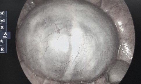 Chủ quan với cơn đau bụng, phát hiện u buồng trứng 14cm