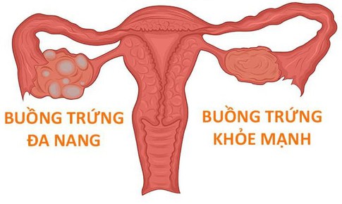 Phụ nữ mắc hội chứng buồng trứng đa nang có mang thai được không?