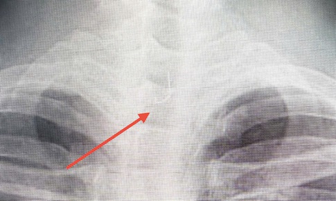 Sau ăn cá người đàn ông 46 tuổi bị mắc lưỡi câu sâu trong thực quản