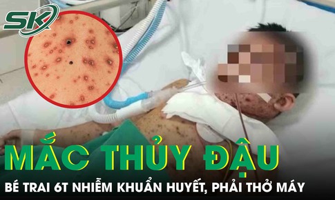 Biến chứng thủy đậu, bé trai 6 tuổi nhiễm khuẩn huyết, phải thở máy nguy kịch
