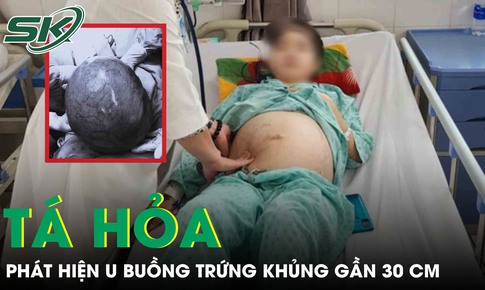 Tá hoả phát hiện khối u buồng trứng ‘cực khủng’ gần 30cm từ dấu hiệu đau bụng