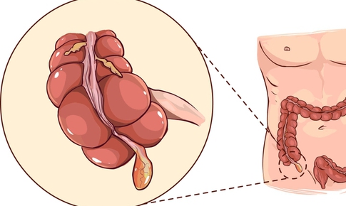 Viêm ruột thừa dễ nhầm lẫn và có thể gây biến chứng gì?