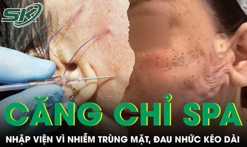 Căng chỉ nâng cơ ở spa, người phụ nữ nhập viện vì nhiễm trùng mặt