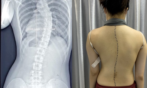 Vẹo cột sống ở trẻ gây hệ lụy gì?