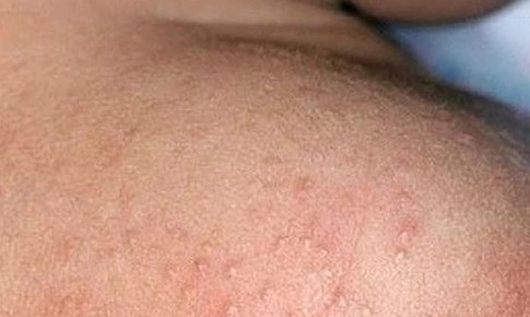 Mùa hè nhiều rôm sảy cần xử trí ra sao?