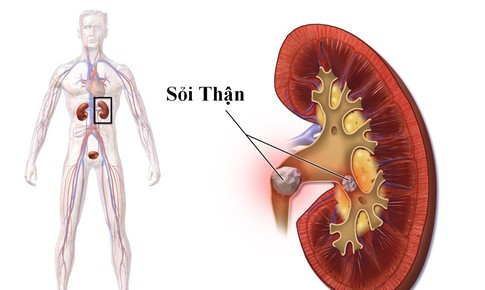 Nhập viện vì sỏi thận, chuyên gia khuyến cáo cần phát hiện sớm khi có biểu hiện này