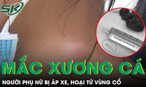 Xương cá nằm trong họng 5 tháng gây áp xe hoại tử vùng cổ