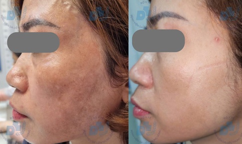 Bác sĩ chỉ rõ lý do nhiều người trị nám tốn kém nhưng vẫn tái phát