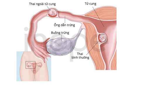 Hiếm gặp: Vừa có thai trong tử cung vừa có thai ngoài tử cung