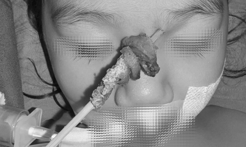 Tai nạn hy hữu: Bé gái 2,5 tuổi bị que xiên thịt đâm sâu, nguy cơ xuyên sọ não