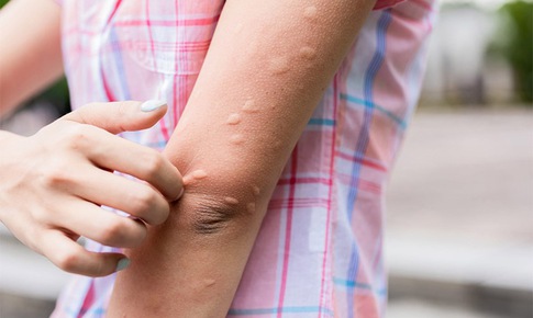 Mề đay dễ bùng phát khi nắng nóng: 3 cách làm giảm ngứa, dịu da