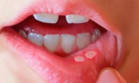 Phân biệt nhiệt miệng và ung thư lưỡi: Cách nhận biết sớm căn bệnh nguy hiểm