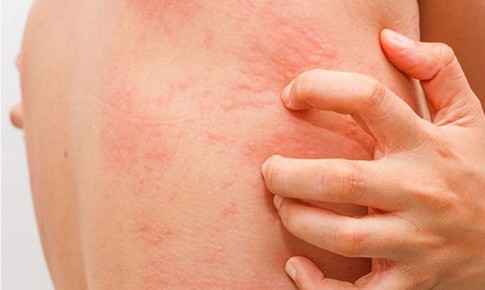 Da nổi mẩn đỏ, ngứa: dấu hiệu dị ứng hay cảnh báo bệnh lý tiềm ẩn?