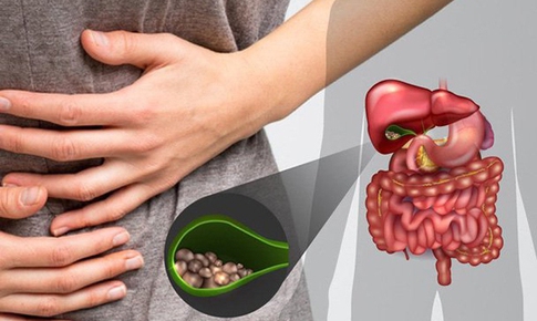 Bệnh sỏi túi mật phổ biến nhưng thường bị xem nhẹ, cảnh báo biến chứng nặng