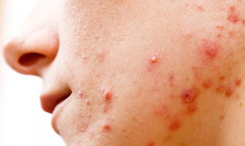 Mụn trứng cá bọc có nên nặn không?