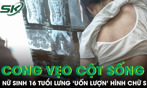 Tự ý ngừng đeo nẹp vì sợ bạn bè trêu chọc, nữ sinh 16 tuổi đối mặt nguy cơ mổ cột sống