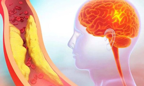 5 dấu hiệu cảnh báo thiếu máu não do hẹp động mạch cảnh