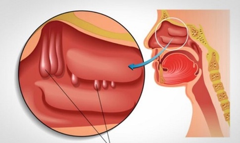 Nghẹt mũi, khó thở là biểu hiện của bệnh gì?