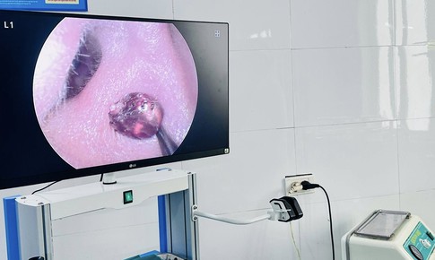 Đau nhức tai suốt một tuần, người phụ nữ tá hỏa vì 'vị khách lạ' trong tai