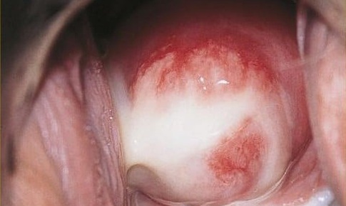 Những dấu hiệu cảnh báo nhiễm khuẩn Chlamydia gây nguy cơ vô sinh