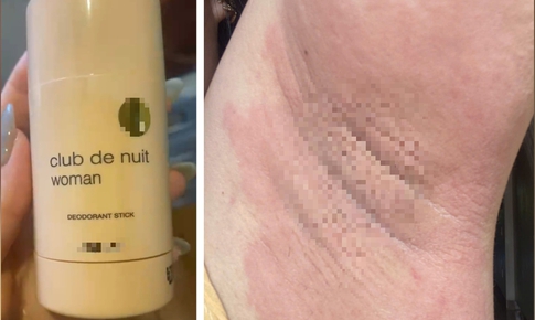 Nổi mề đay, đau nhức vùng nách rồi lan khắp cơ thể sau khi dùng lăn khử mùi 'hàng Nhật' xách tay