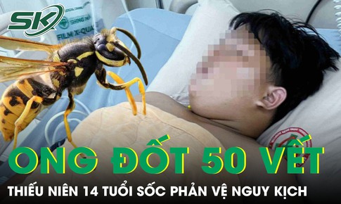 Bị ong vò vẽ đốt hơn 50 vết, thiếu niên 14 tuổi hoại tử, sốc phản vệ nguy kịch