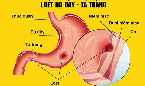 Những nguy cơ khi tự ý dùng meloxicam trị đau xương khớp