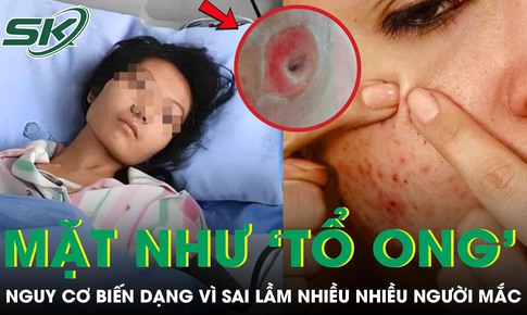 Người phụ nữ chết lặng khi thấy mặt như 'tổ ong', nguy cơ biến dạng vì sai lầm nhiều người mắc