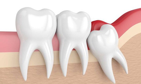 Răng số 8 mọc lệch không đau có cần nhổ?