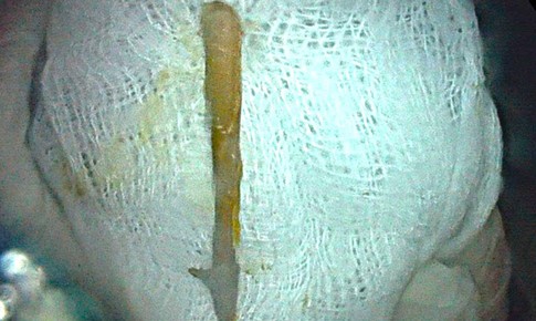 Đi cấp cứu vì tiêu chảy ra máu, phát hiện dị vật dài 3cm đâm thủng đại tràng