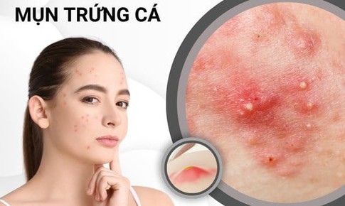 Mụn trứng cá kéo dài tới tuổi nào mới hết?
