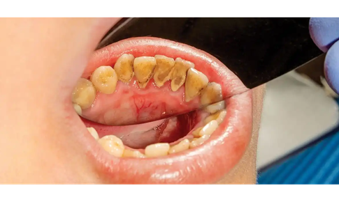 Có cần phải lấy cao răng thường xuyên?
