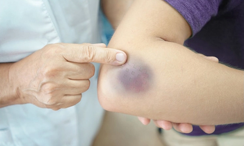 Xuất hiện nhiều vết bầm tím không rõ nguyên nhân cảnh giác với giảm tiểu cầu