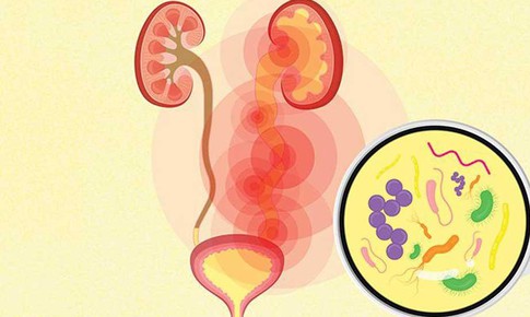 Nhiễm khuẩn tiết niệu có biểu hiện như thế nào?