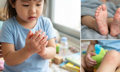 Tay chân miệng ở trẻ em: Những biến chứng cha mẹ không nên chủ quan
