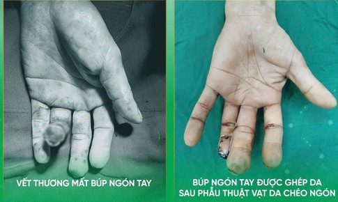 Thêm giải pháp tạo hình cho người bị khuyết hổng đầu ngón tay