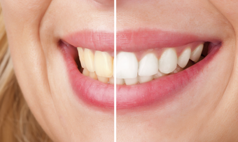 4 hệ luỵ nếu tẩy trắng răng sai cách
