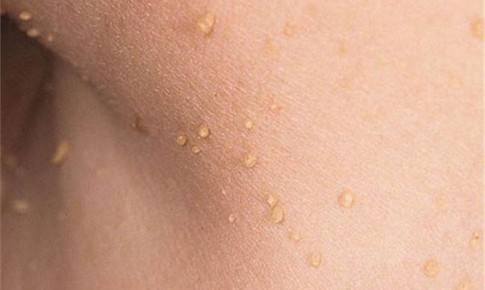 Vì sao mụn thịt thường mọc quanh mắt, xử trí thế nào?