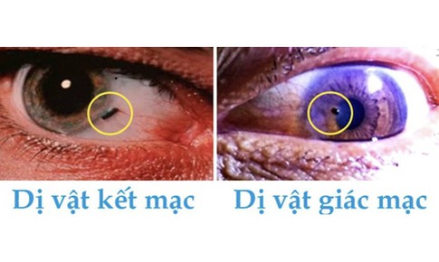 Cảnh báo dị vật mắt khi lao động gây thủng giác mạc