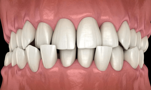 10 dấu hiệu cần chỉnh nha sớm ở trẻ em, đừng đợi đến khi con mọc đủ răng mới đi khám