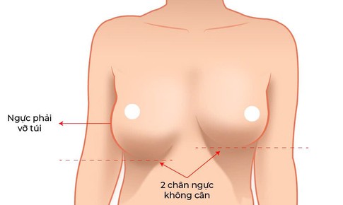 Vì sao xử lý túi ngực bị vỡ và đặt lại túi mới khó hơn nhiều so với nâng ngực lần đầu?